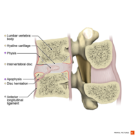 Intervertebral disc hernia into anterior body sagittal view Primal.png