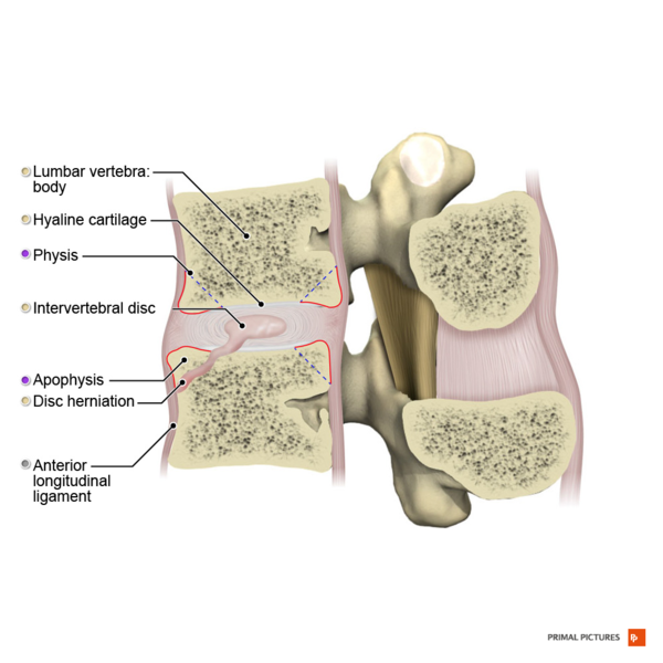 File:Intervertebral disc hernia into anterior body sagittal view Primal.png