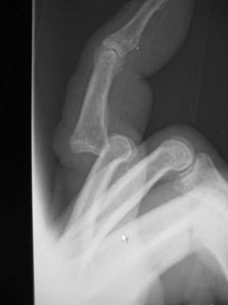 File:PIP Joint dilocation X-ray.jpg