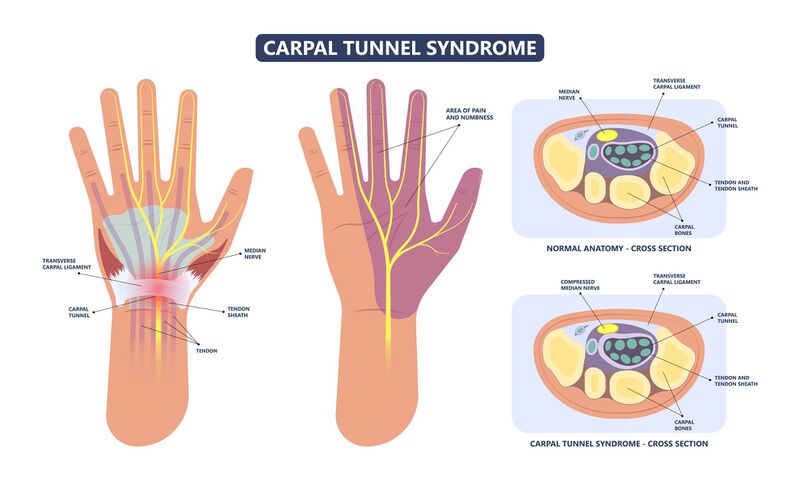 File:Carpal Tunnel Syndrome shutterstock 1956398119 resized.jpg