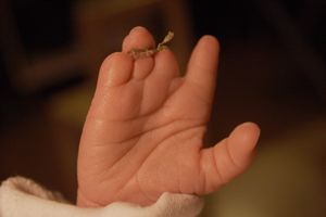 Image showing a baby hand affected by amniotic band syndrome, also known as constiction ring syndrome
