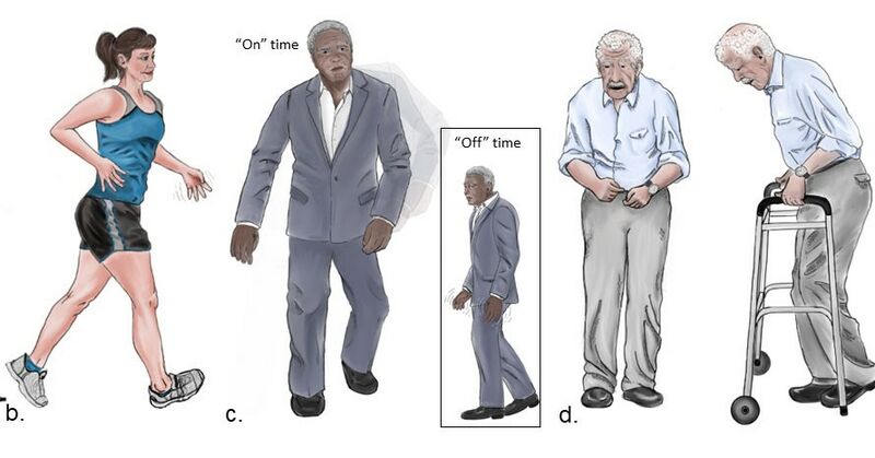 File:Parkinson disease representation.jpeg