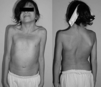 A female patient with chest malformations and rib abnormalities