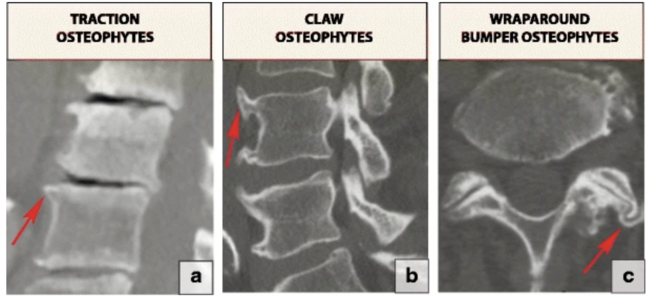 Periarticular Marginal Osteophytes: Criteria For Grade 0, 1, 2, 3 ...