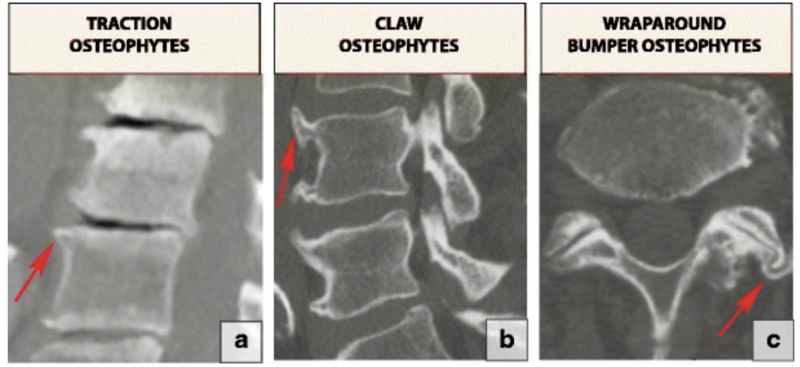 File:Osteophytes.png