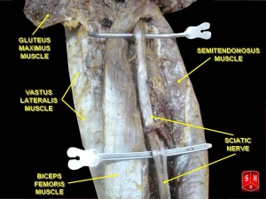 Sciatic nerve 2.jpg