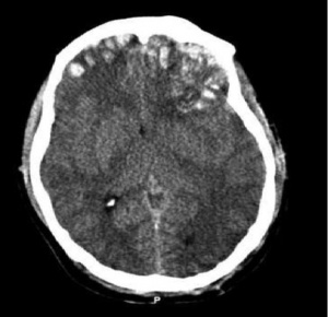 PP-Brain trauma CT.jpg