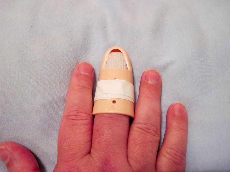 File:Finger splinting.jpg