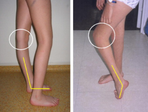 Flexion Deformity of the Knee - Physiopedia