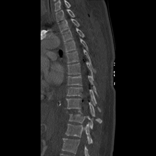 File:Unstable-thoracic-spine-fracture-dislocation.jpg