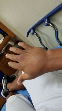https://www.physio-pedia.com/images/thumb/f/f1/Hand_injury.jpg/200px-Hand_injury.jpg