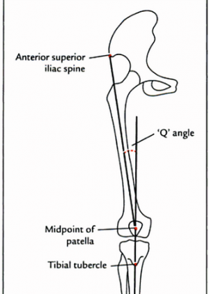 Example of patellar orientation with a lateral glide and/or tilt