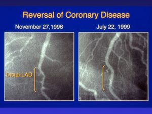 Coronary Artery Disease diet.jpg