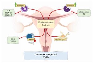 Endometriosis - Physiopedia