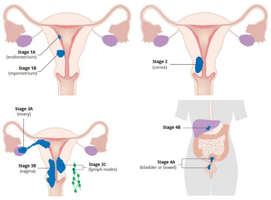 File:Endometrial cancer stages.webp