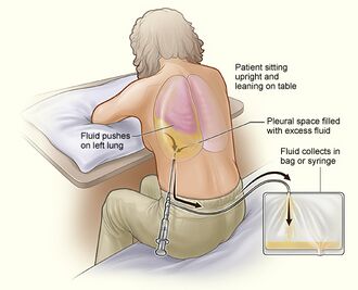 The illustration shows a person having thoracentesis. The person sits upright and leans on a table. Excess fluid from the pleural space is drained into a bag.