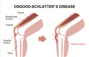 Osgood Schlatters Disease.png