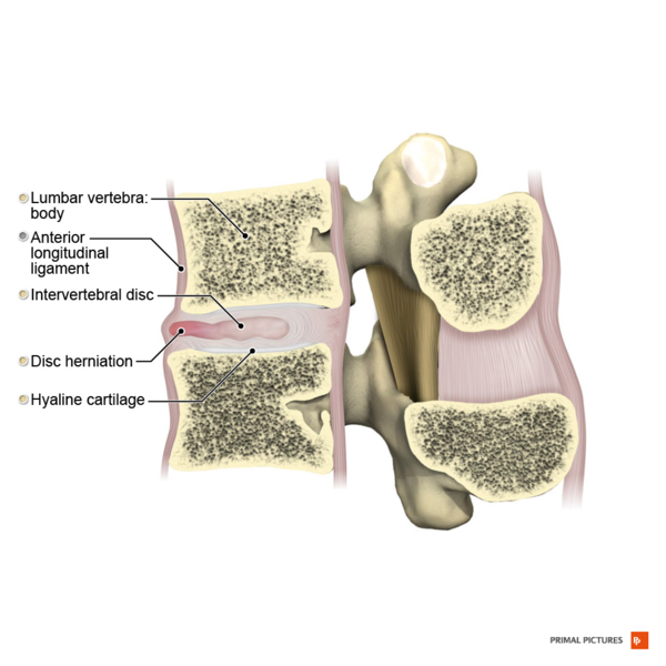 File:Anterior disc hernia sagittal view Primal.png