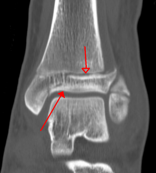File:Triplane fracture CT.png