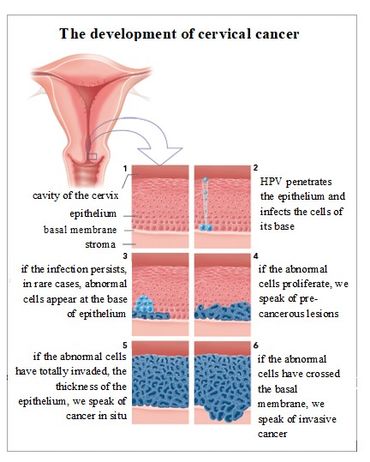 The development of cervical cancer.jpg