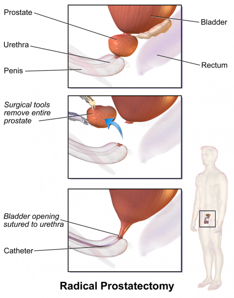 File:Prostate Removal.png