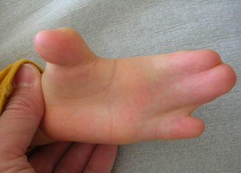 Image showing a hand with congenital deformity in Apert syndrome