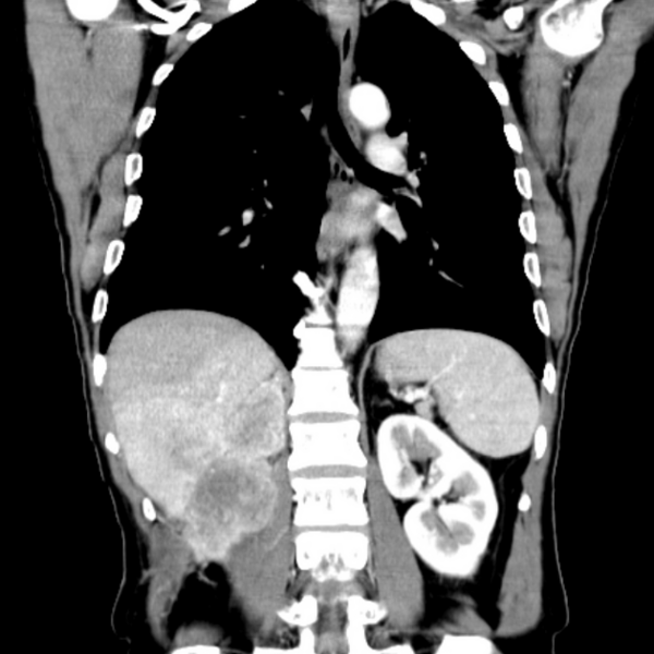 File:Recurrent renal cell carcinoma.png