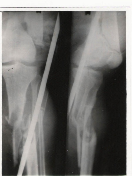 File:Floating knee fracture 2.jpg