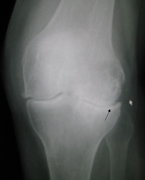 File:Knee osteoarthritis xray.jpg