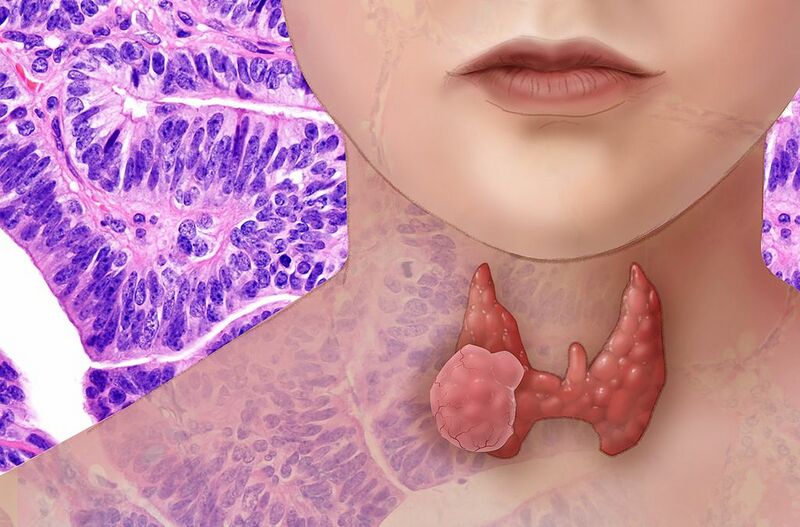 File:Thyroid Cancer diagram.jpeg