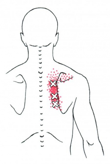 Muscle extenseur ulnaire du carpe : douleurs et trigger points